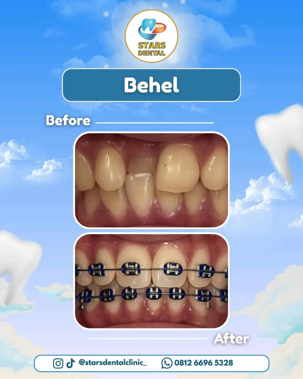 behel