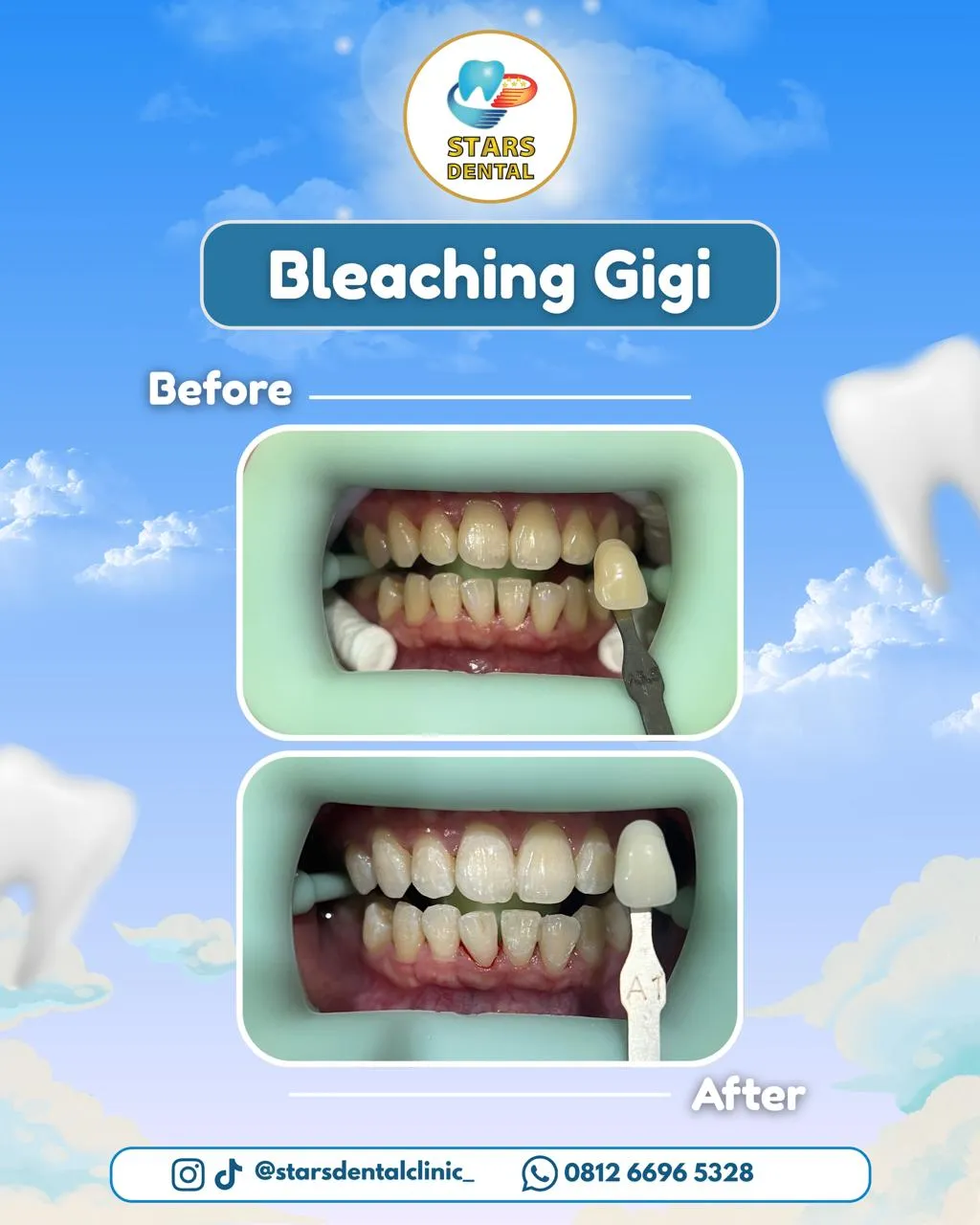 bleaching