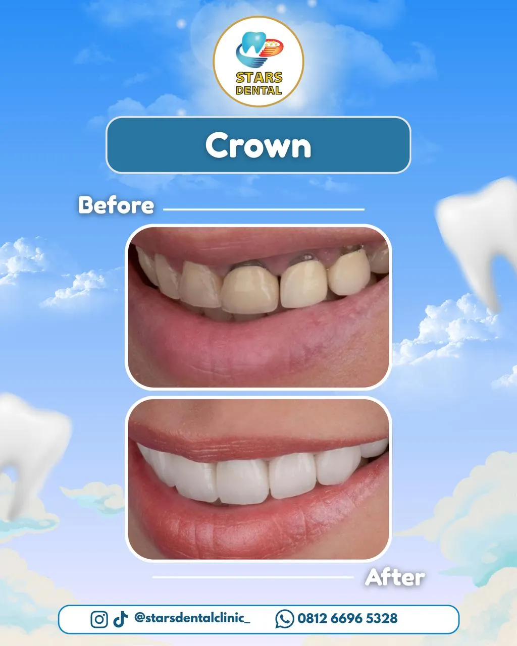 crown