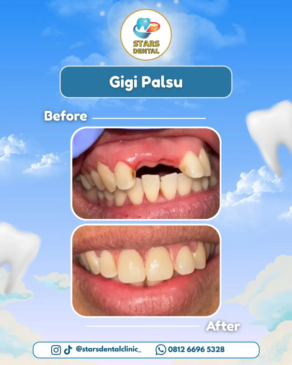 gigi palsu