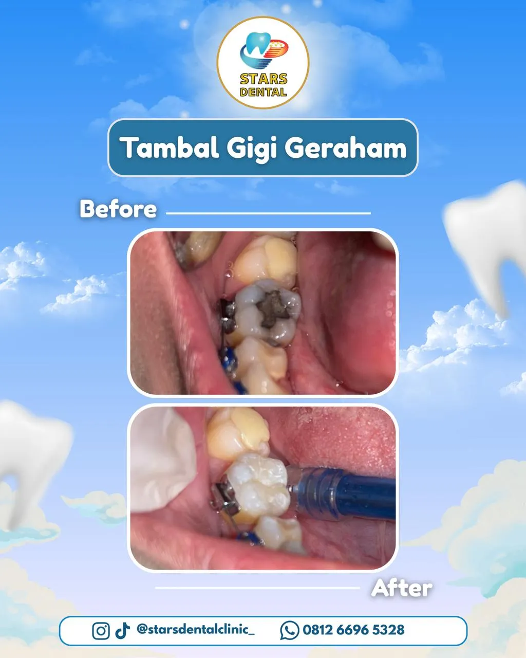 tambal belakang