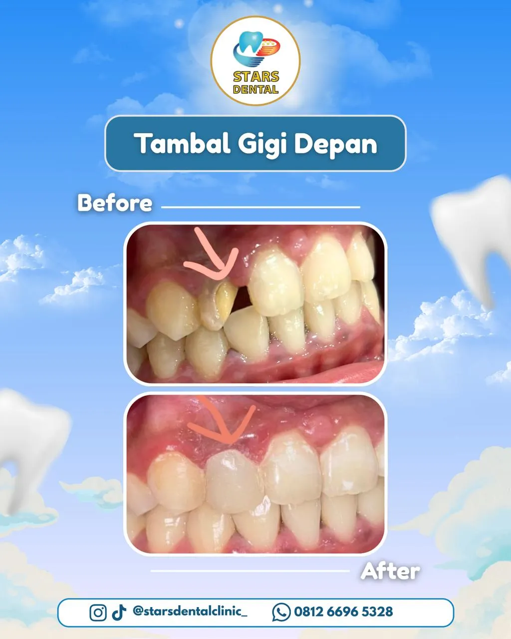 tambal depan