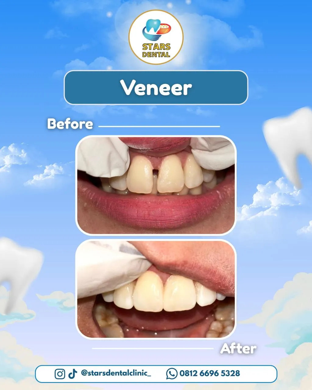 veneer